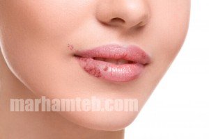 تفاوت تبخال و زگیل تناسلی + درمان در طب سنتی تفاوت تبخال و زگیل تناسلی + درمان در طب سنتی