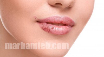 تفاوت تبخال و زگیل تناسلی + درمان در طب سنتی