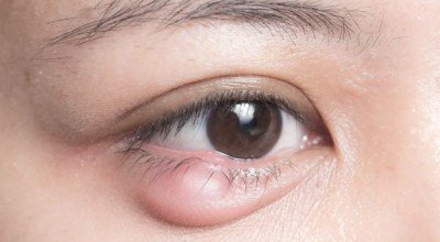 گل مژه و راه های درمان آن در طب سنتی