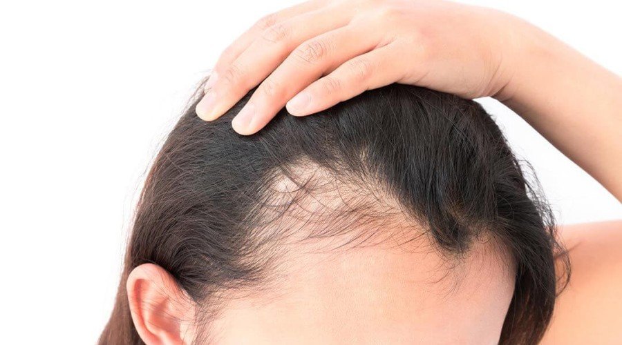 درمان ریزش مو در خانه با رعایت این نکات