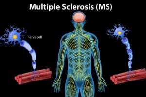 بیماری ام اس (MS) + راه های درمان در طب سنتی بیماری ام اس (MS) + راه های درمان در طب سنتی