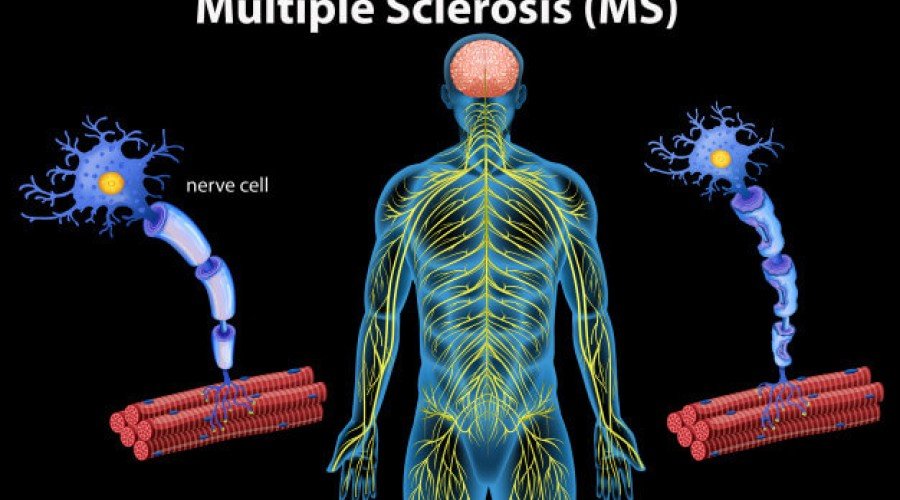 بیماری ام اس (MS) + راه های درمان در طب سنتی
