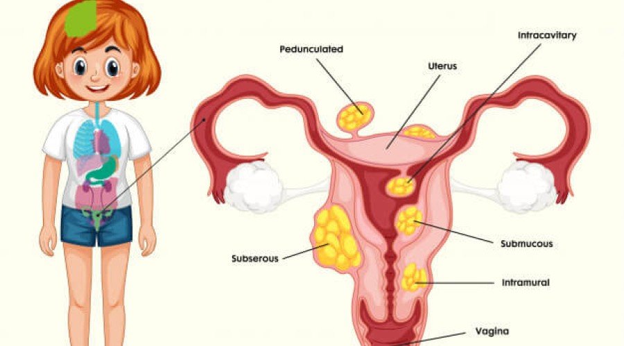 کپسول پونیکا و درمان بیماری های شایع در زنان