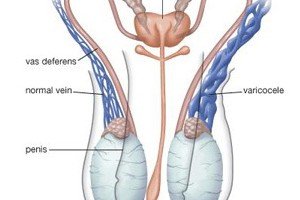 روش درمان واریکوسل در طب سنتی روش درمان واریکوسل در طب سنتی