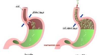 ترش کردن و ریفلاکس معده از نگاه طب سنتی