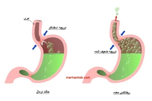 ترش کردن و ریفلاکس معده از نگاه طب سنتی