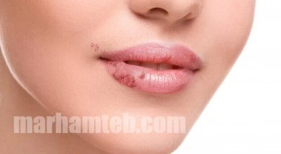 تفاوت تبخال و زگیل تناسلی + درمان در طب سنتی