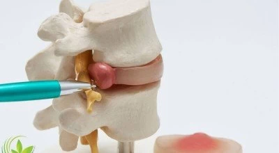 دیسک کمر؛ دلایل و راه های درمان