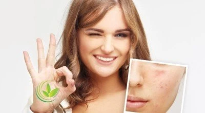 صابون های گیاهی برای درمان جوش و آکنه