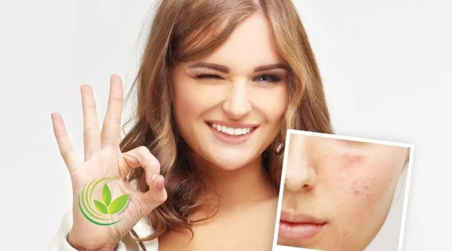 صابون های گیاهی برای درمان جوش و آکنه