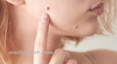 سرطان پوست، علائم و نشانه ها