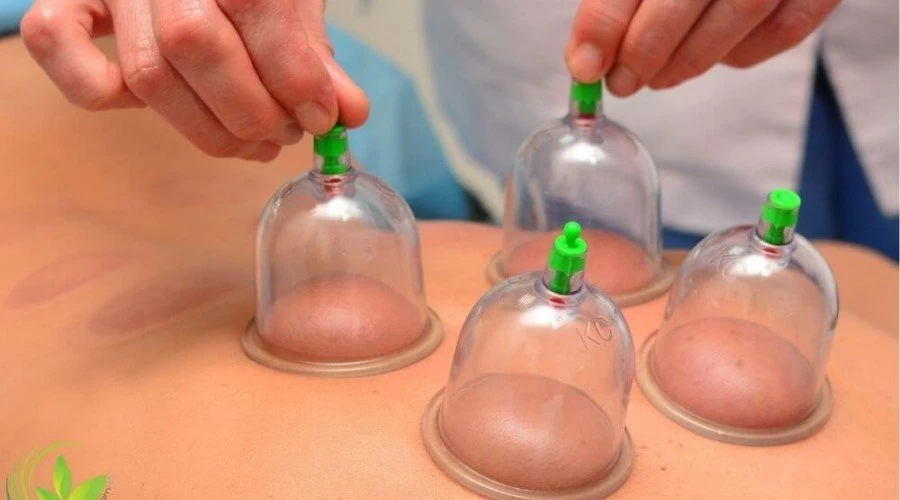 بادکش درمانی و فواید آن در طب سنتی