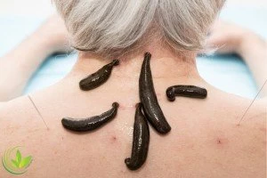 همه چیز درباره زالو درمانی