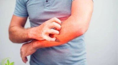 7 نکته مهم برای رهایی از اگزما زمستانی